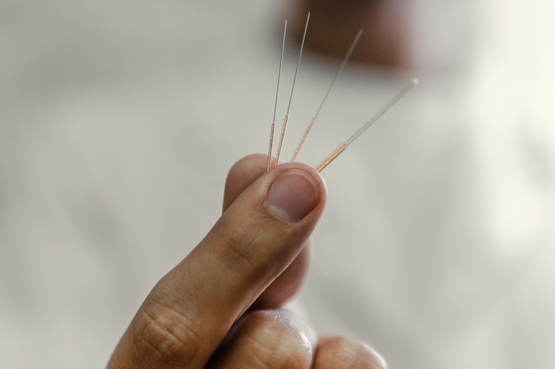 How often will I need acupuncture?