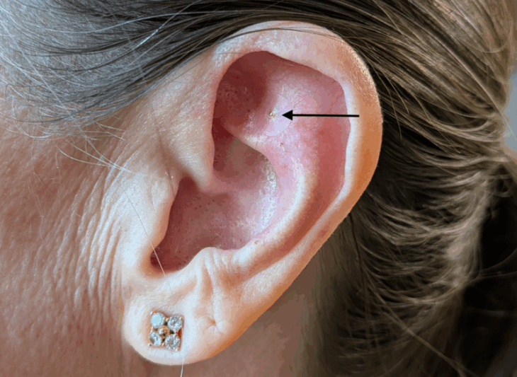 Q-tip in the cave anxiety trick, Ear Shenmen, Austin, TX