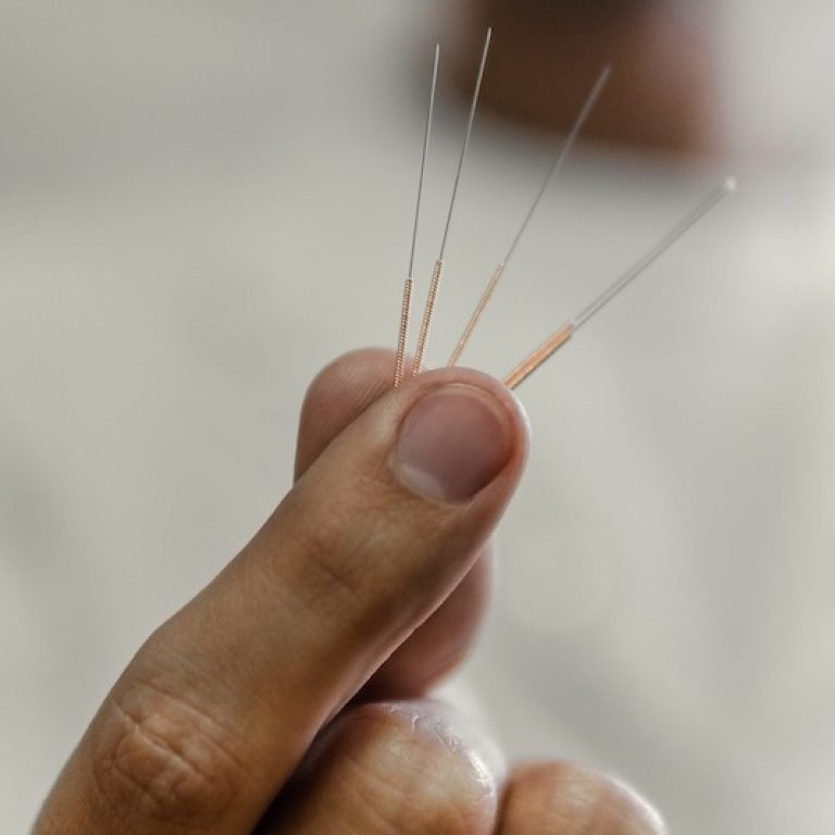 How often will I need acupuncture?